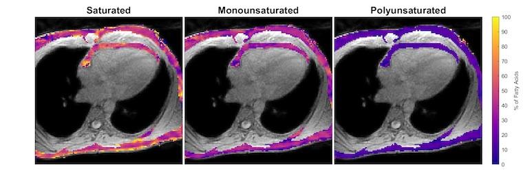 MRI images showing the composition of fat around the heart. The large organ in the middle of each image is the heart, and the dark areas are the lungs. The color bar on the right indicates the percentage of fatty acids.