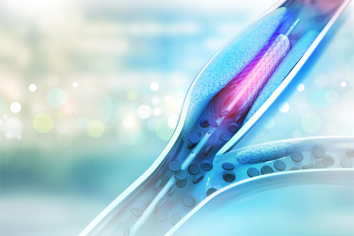 Stent angioplasty procedure