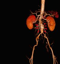 CTA ABDOMINAL AORTA AND FEMORAL RUN OFF  3D rendering.
