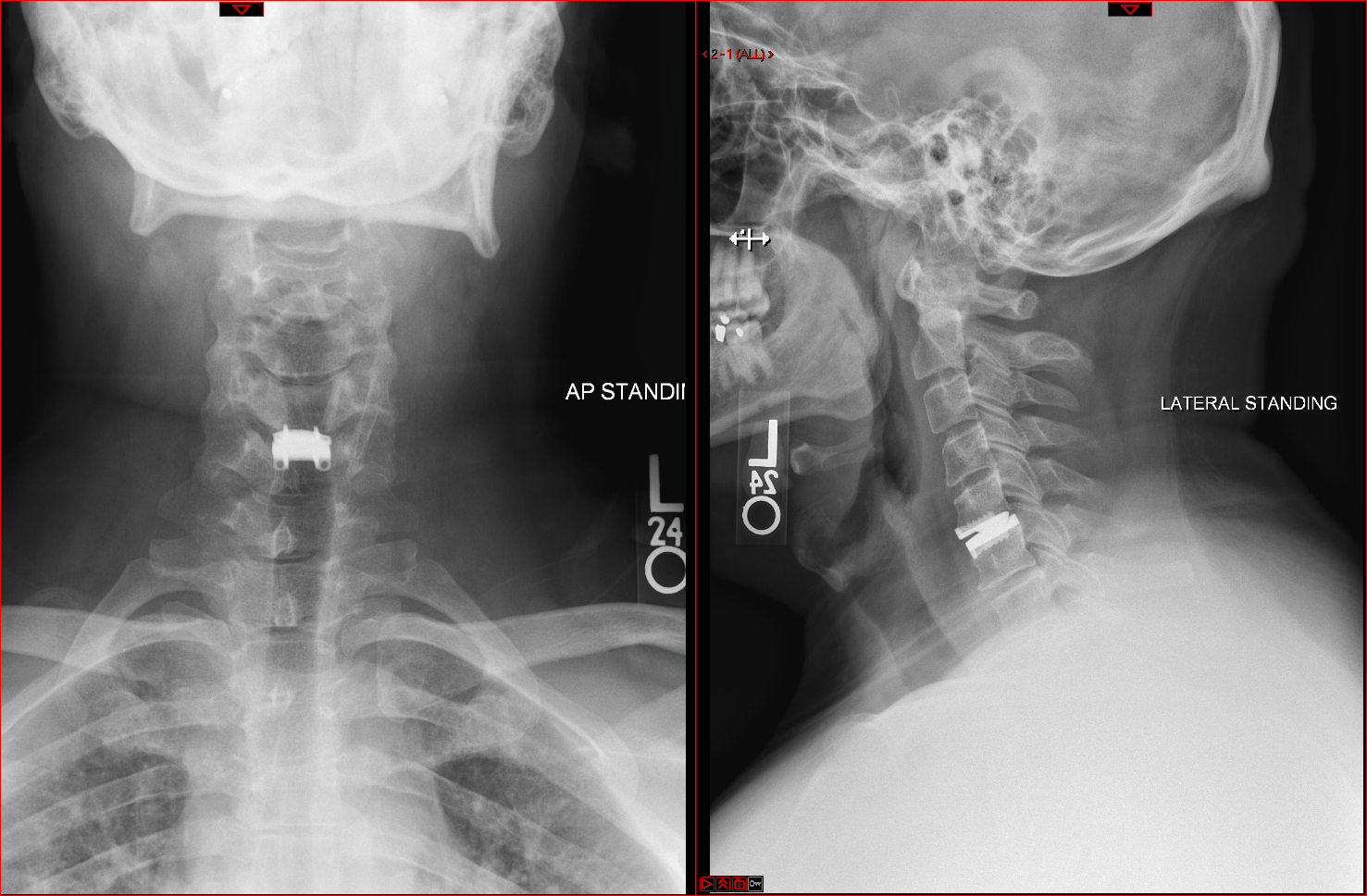 lateral view of spine with disc replacement