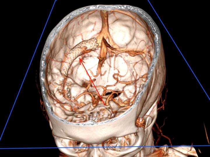 A 3D reconstruction showing the placement of an intracranial venous stent 