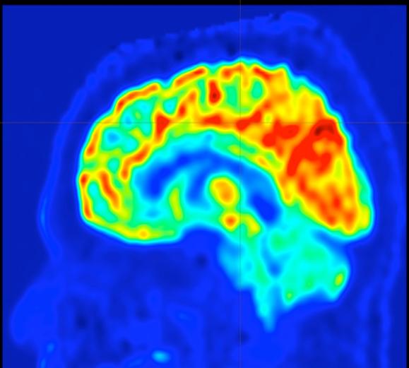 A brain map, created by a new approach developed at UVA, to guide surgery to prevent epilepsy seizures.
