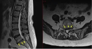 Case Study: Minimally Invasive Transforaminal Lumbar Interbody Fusion (TLIF)
