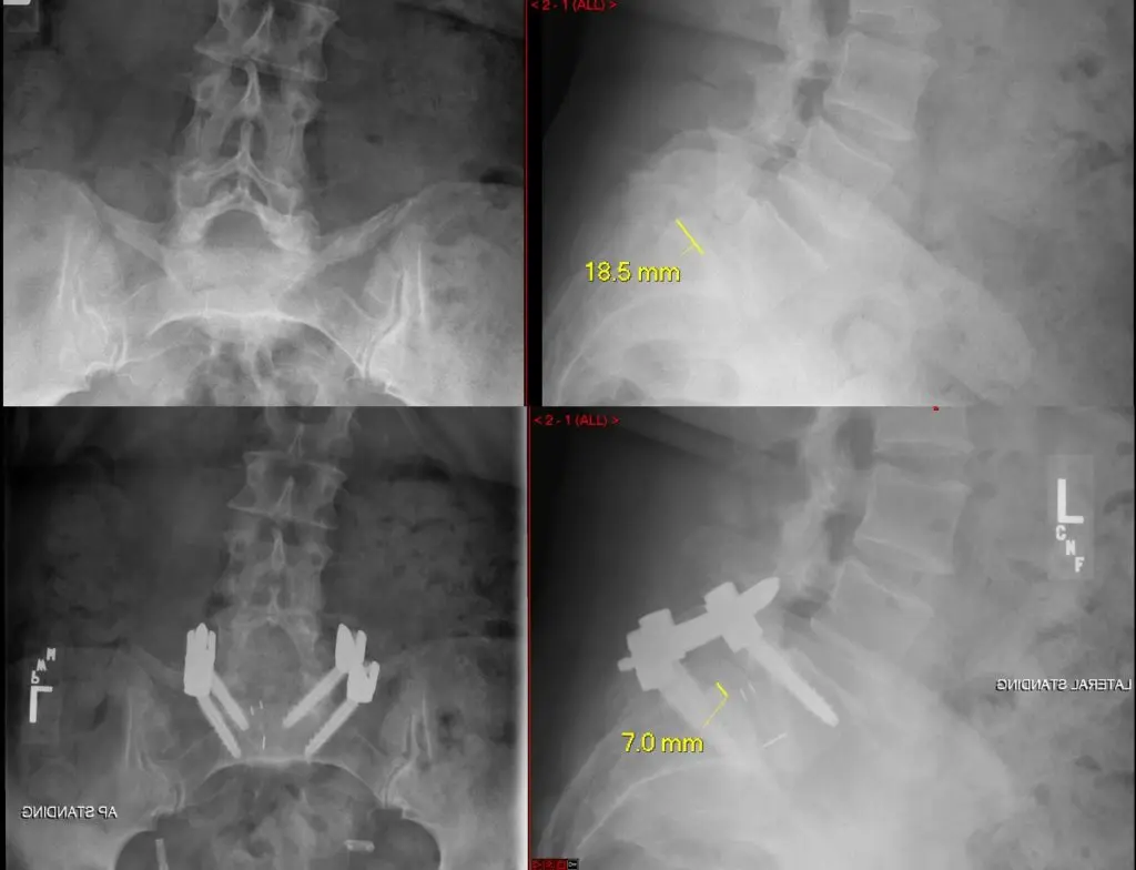 Case Study for Spondylolisthesis Reveals the Benefits of Robotic Spine Surgery