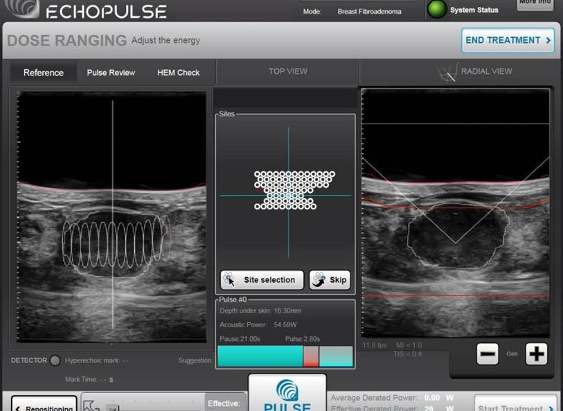 Each ovoid (viewed from the side) and each circle (viewed from the top) represent a single sonication zone in the focused ultrasound ablation treatment plan.
