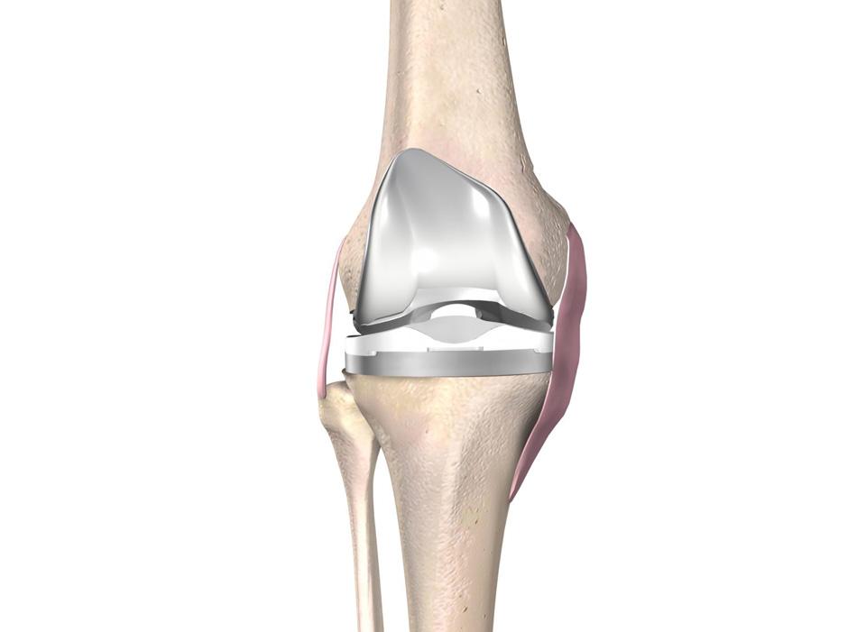 illustration shows what a knee implant looks like 