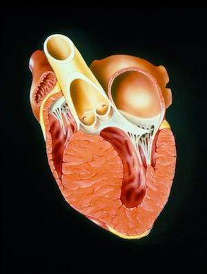 Hypertrophic cardiomyopathy is a genetic disease that leads to abnormal hypertrophy of the heart muscle.