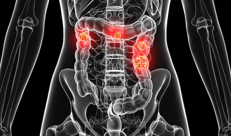 Colorectal cancer is the third most commonly diagnosed cancer in the United States. The American Cancer Society estimates that this year there will be 104,270 new cases of colon cancer and 45,230 cases of rectal cancer in the U.S. 