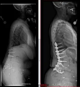 Sixth Time Is a Charm: A Case Study Highlighting a Complex Revision Spine Surgery