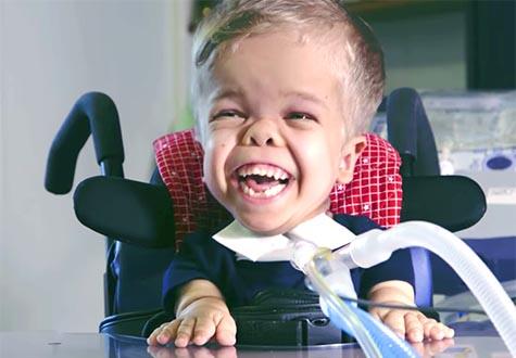 Charlie Davison has a rare form of dwarfism