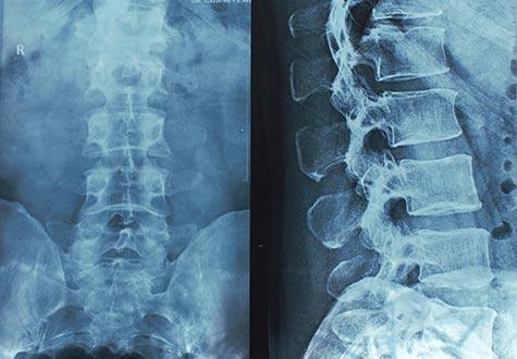 spine x-rays