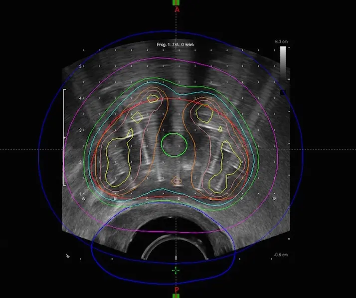 High-Dose Rate Brachytherapy: Part of a Proven Approach to Treating Intermediate- and High-Risk Prostate Cancers