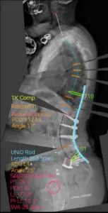 Sixth Time Is a Charm: A Case Study Highlighting a Complex Revision Spine Surgery