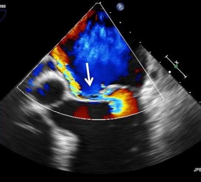 Preop Posterior Leaflet Flail (Torn leaflet) indicated by arrow, with color flow into left atrium