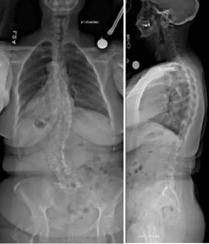 scoliosis xray