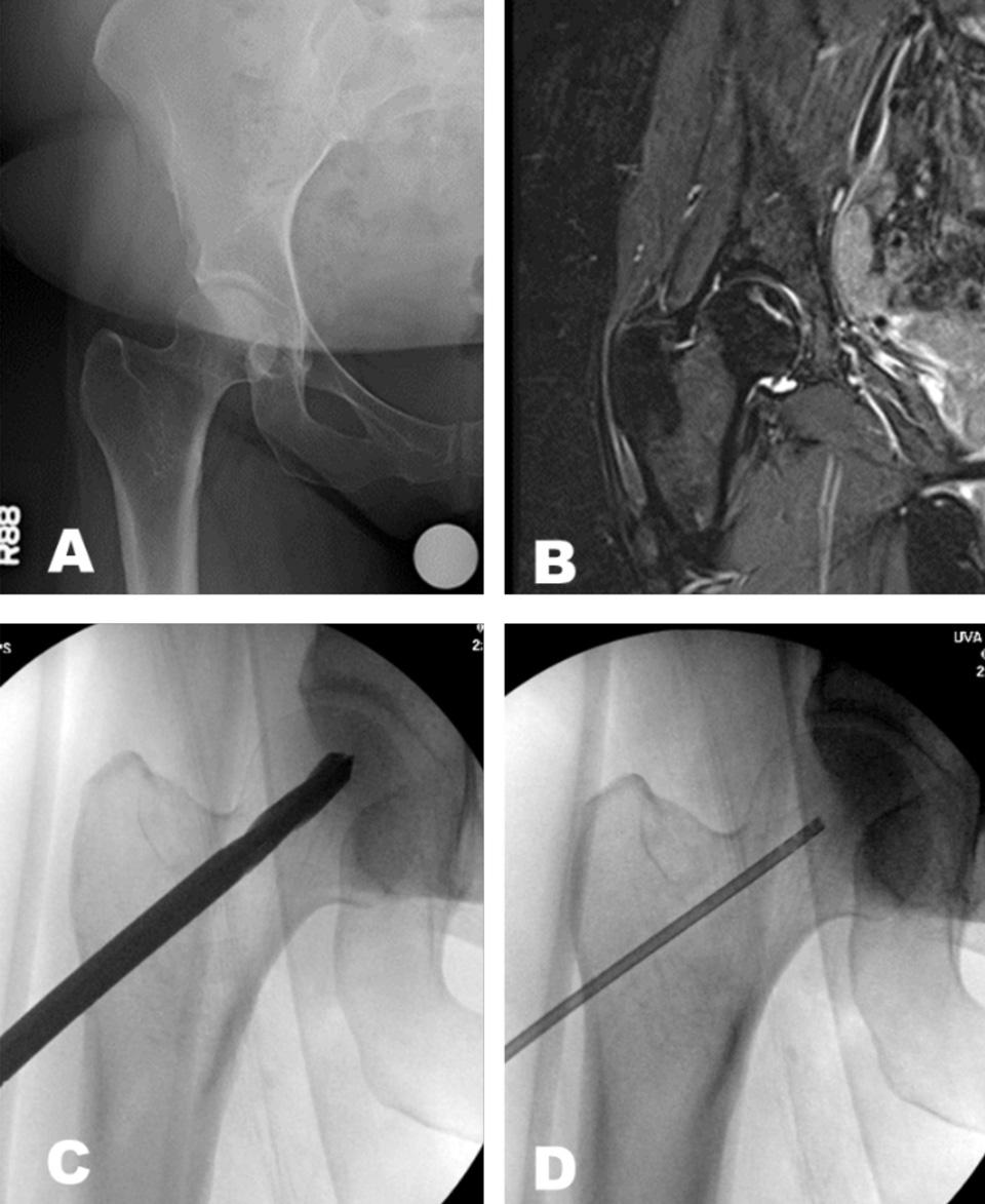 Imaging of the hip showing the femoral head and hip socket.