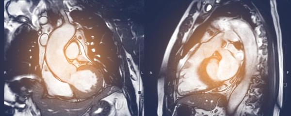 A scan of fat around the heart