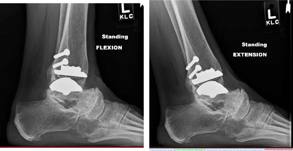 Case Study: Total Ankle Arthroplasty