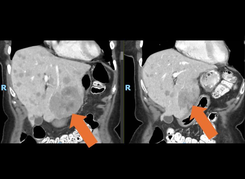 These scans show tarlatamab treatment response in a patient's largest hepatic tumor prior to treatment, at left, and after 6 weeks of treatment
