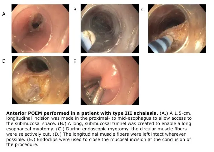 Minimally-Invasive Procedure to Treat Achalasia Is Part of Emerging Field of Advanced Gastrointestinal Endoscopy