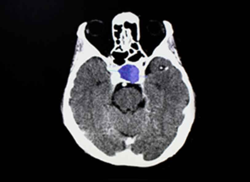Imaging shows pituitary tumor in brain