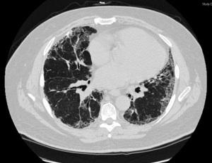 A high resolution CT scan of the chest showing a bilateral peripheal reticular pattern and subpleural honeycombing of the lungs