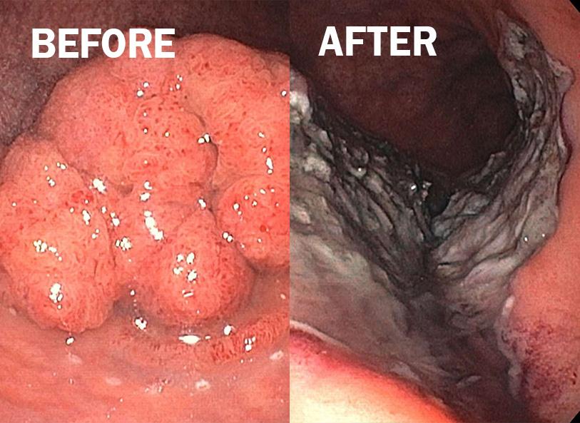 Greater than 9 cm advanced rectal adenoma before/after endoscopic submucosal dissection