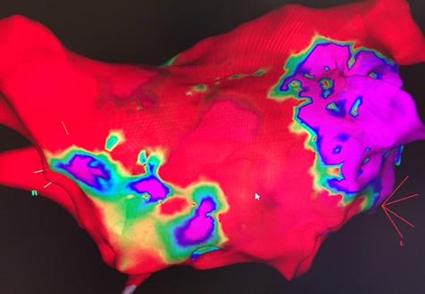 Heart flutter electrical activity in the heart.