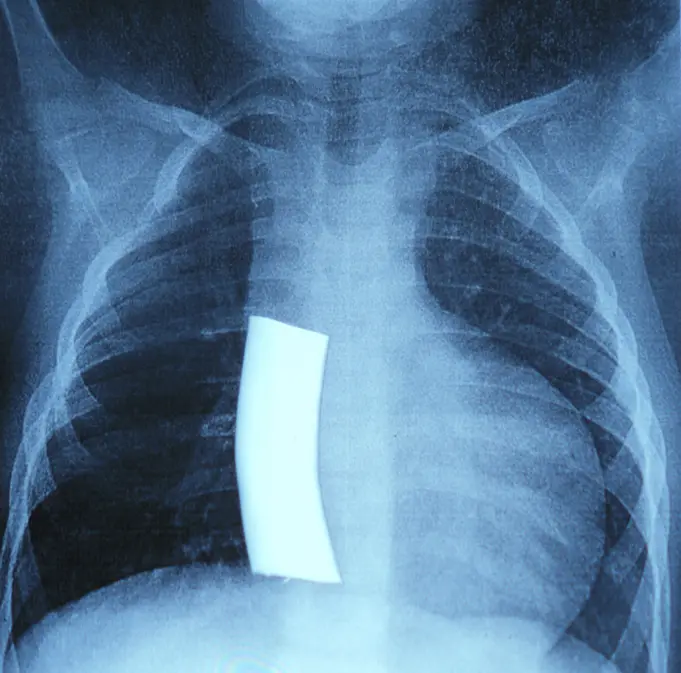 X-ray of infant with hypoplastic left heart syndrome