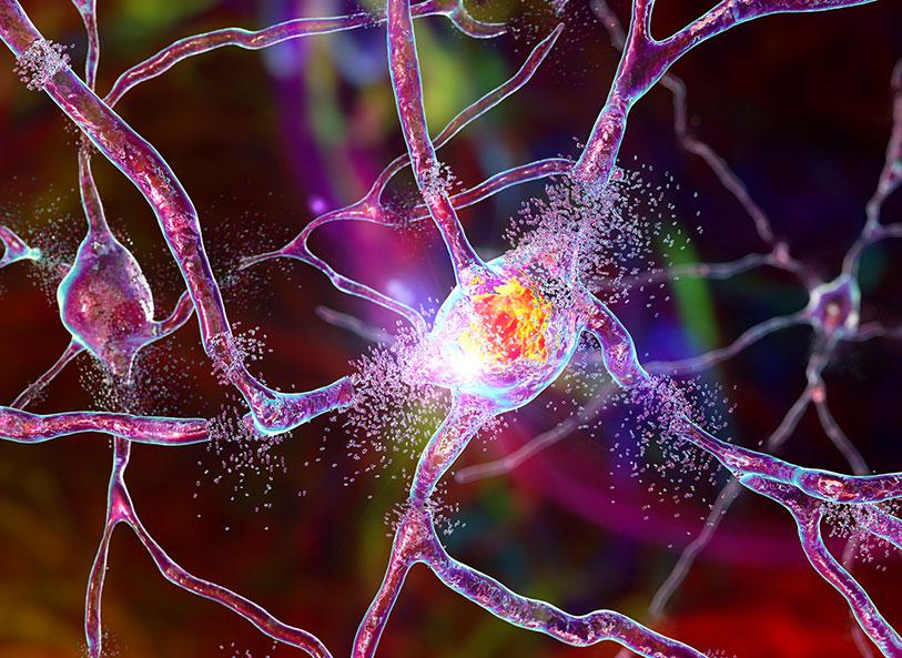 University of Virginia neuroscientist George Bloom, PhD, studies how Alzheimer's disease develops biochemically in order to improve the prognosis for patients