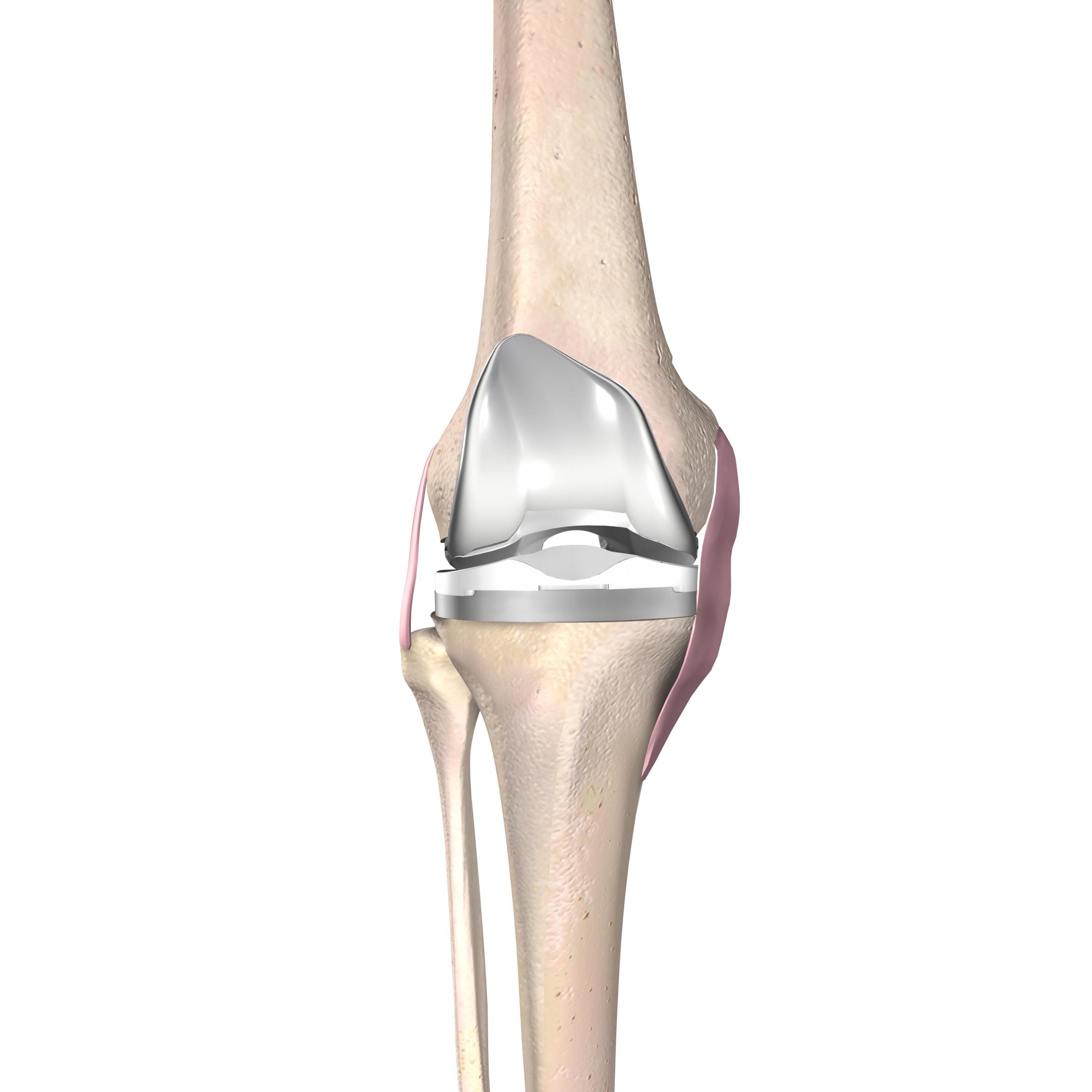 The Forgotten Joint: UVA Health Improves Knee Replacement Durability