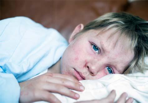 school-age boy with a rash from measles