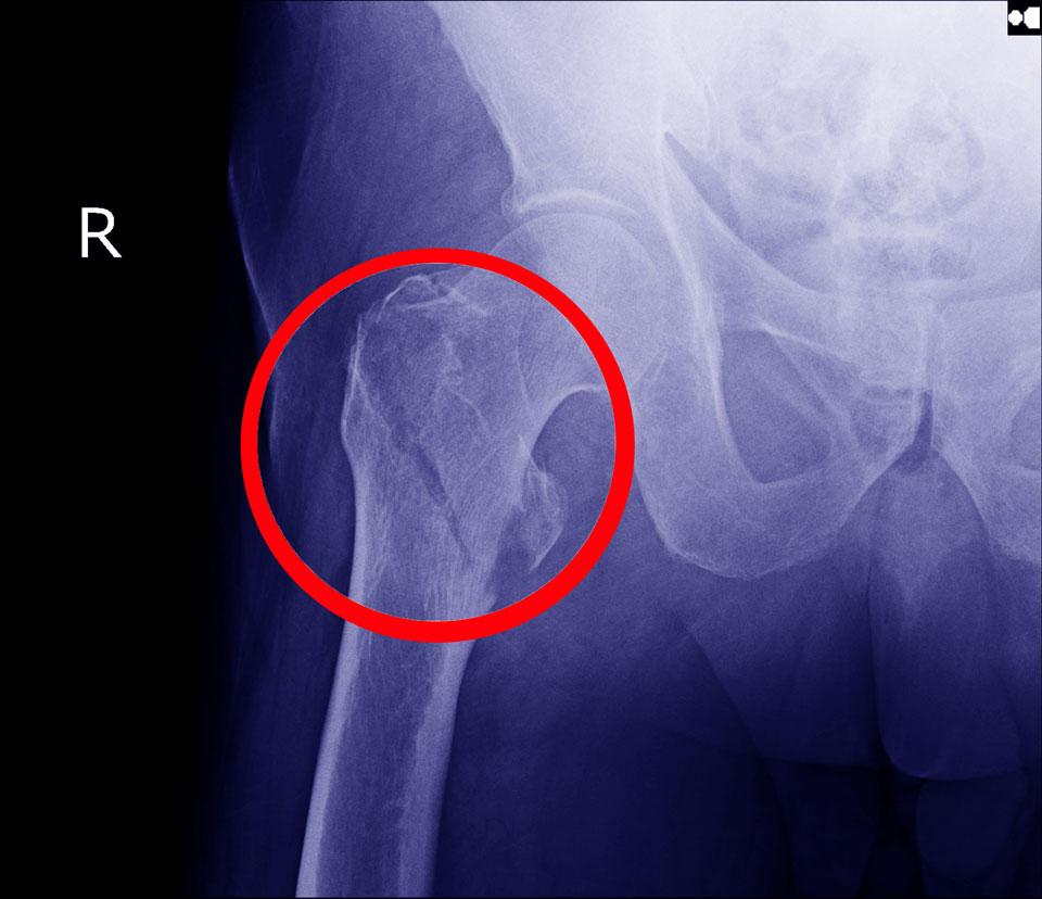 geriatric hip fracture