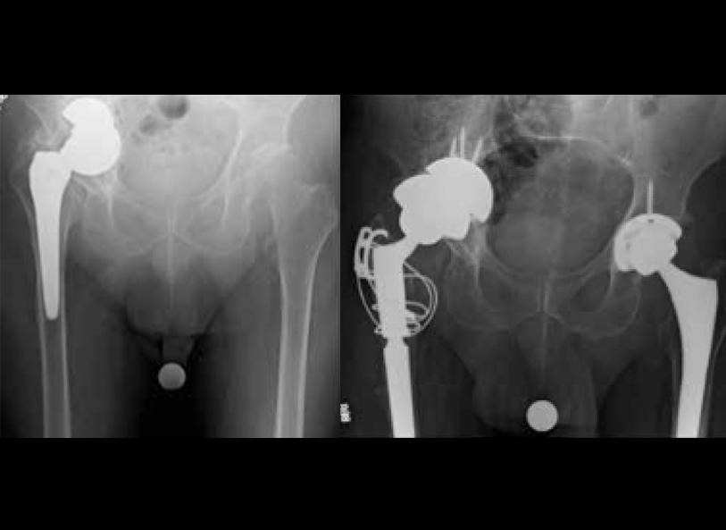 AP pelvis radiograph from July 2016 versus AP pelvis radiograph of final construct