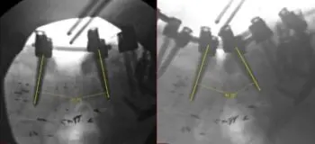 Sixth Time Is a Charm: A Case Study Highlighting a Complex Revision Spine Surgery